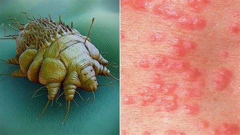 Scabies Causes Symptoms Pictures Of Rash And Treatment Everyday