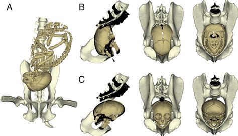 Covariation Of Fetal Skull And Maternal Pelvis During The Perinatal