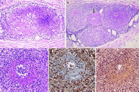 A Sarcoid Granuloma With Venulitis Showing Destruction Of Vascular