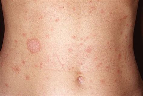 Pityriasis Rosea My Strange Full Body Rash Youmemindbody