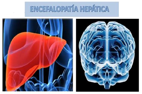 Encefalopatía Hepática Síntomas Tratamientos Causas e Información Y