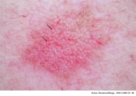 Precancerous Skin Lesions Actas Dermo Sifiliográficas