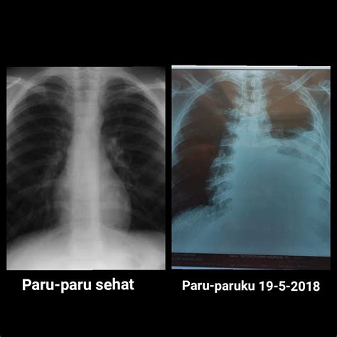 Gambar Paru Paru Sehat Serat