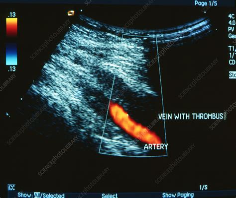 Doppler Ultrasound Showing Deep Vein Thrombosis Stock Image M175
