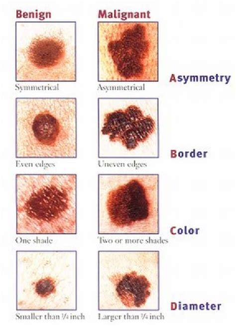 Know Your Own Skin Bunbury Skin Cancer Clinic