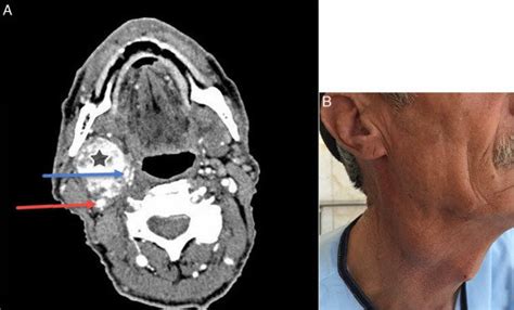 A Spiral Neck Ct Scan With Iv Contrast Shows Cbt Star Ica Red