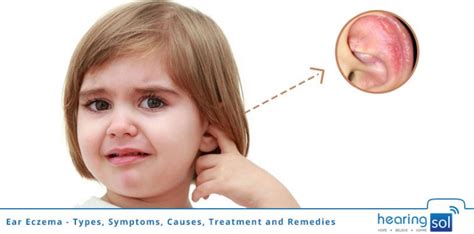 Ear Eczema Symptoms Causes Treatment And Best Remedies