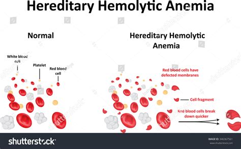 Hereditary Hemolytic Anemia Diagram Stock Vector Illustration 346367561