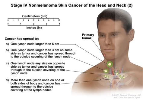 Skin Cancer Treatment Pdq®health Professional Version Siteman