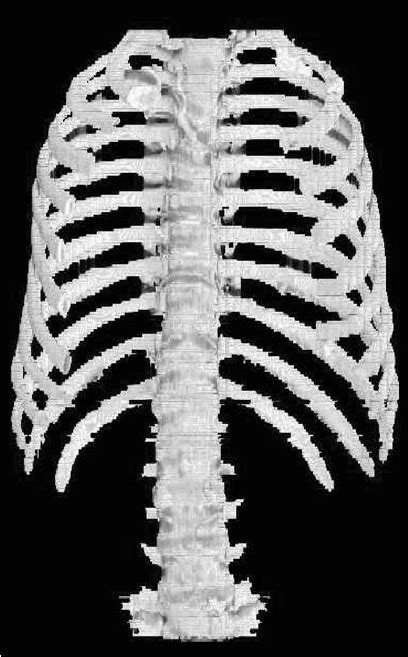 3d Ct Image After Processing To Extract The Ribs And Vertebrae The