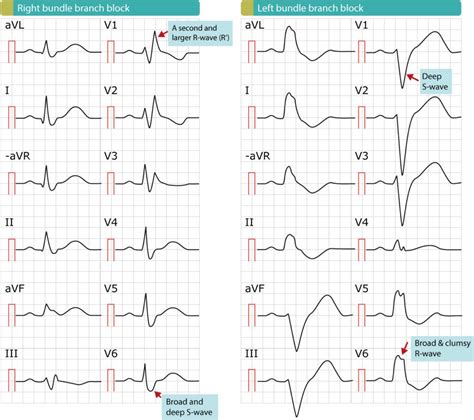 Figure 2 Right Bundle Branch Block Rbbb And Left Bundle Branch Block
