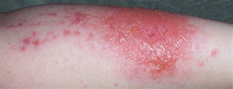 Contact Dermatitis Scabies Staph Strep Or Mrsa Name That Rash