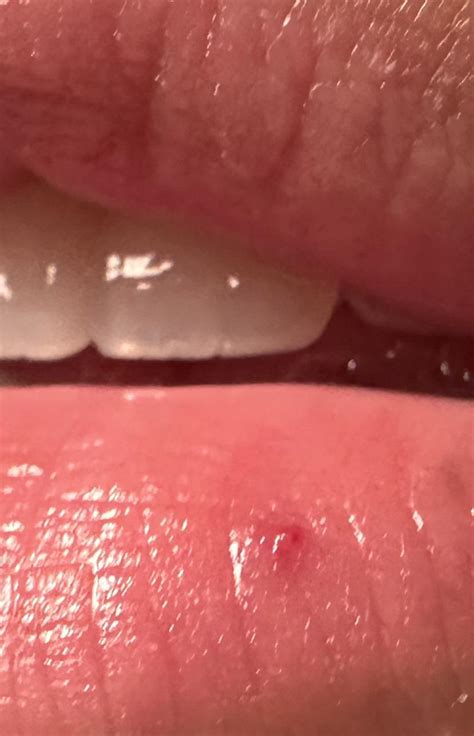 Red Bump On Lip Not A Cold Sore Rdermatologyquestions