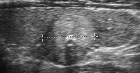 Sonographic Patterns Of Benign Thyroid Nodules Verification At Our