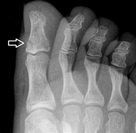 Oblique View Of The Great Toe Demonstrating A Nondisplaced Transverse
