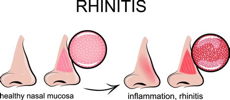 Chronic Rhinitis Ent Florida