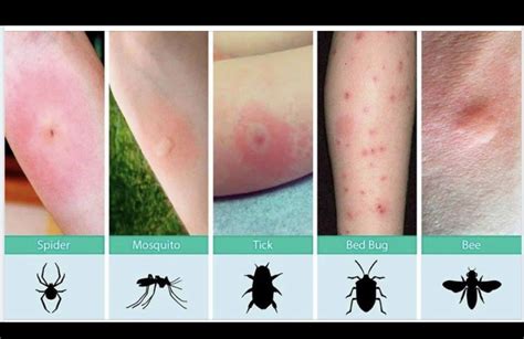 Pictures Of Baby Bed Bug Bites Get More Anythink S