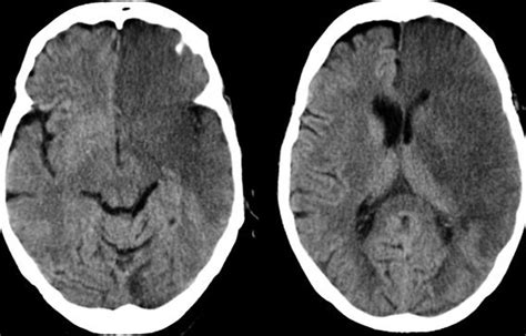 Infarction Left Cerebral Infarct