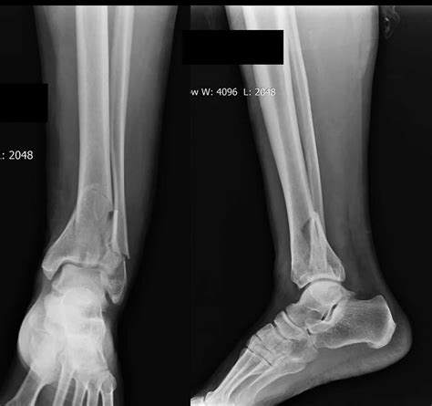 Intra Articular Fracture Tibia