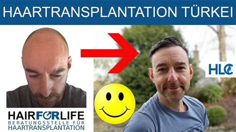 Haartransplantation Türkei Glatze Vorher Nachher 1 Haarschnitt seit