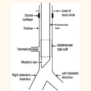 Schematic Diagram Showing Position Of The Endotracheal Tube Cuff At The