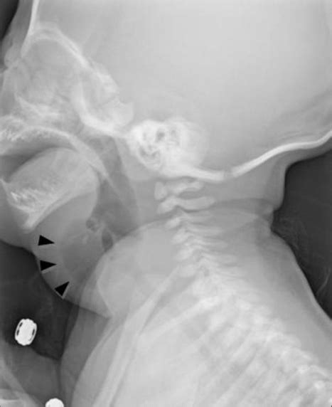 Left Lateral Neck X Ray Finding An Air Fluid Level Within The Mass In