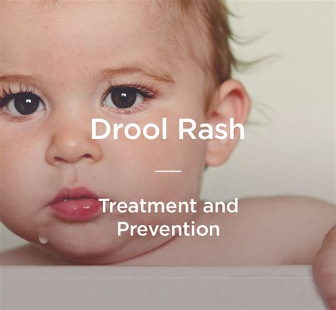 Drool Rash How To Prevent And Treat It