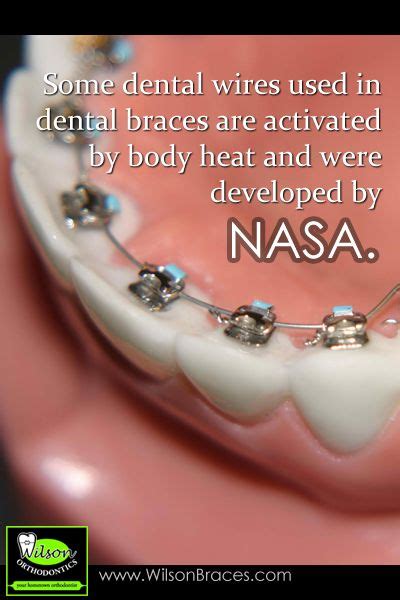 Braces Are Activated By Body Heat Dental Braces Dental Facts Dental Fun Facts