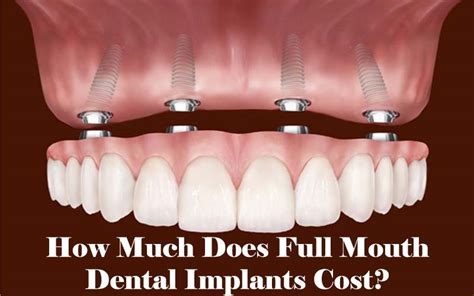 Each type of vehicle also requires different parts with equally different prices. How much for a full set of dental implants - All About Dental