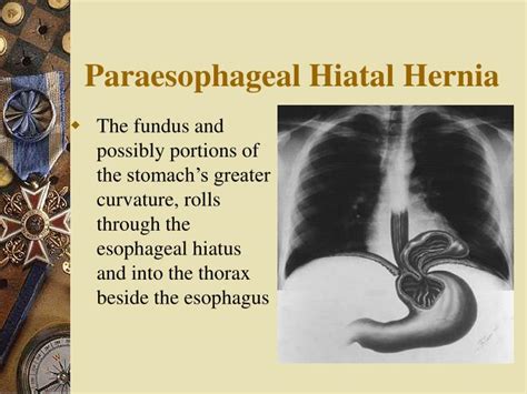Ppt Diaphragm And Hiatus Hernia Powerpoint Presentation Id3094188