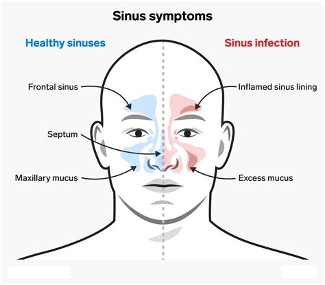 Post Covid Sinus Infections Nose And Sinus Related Problems