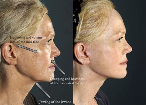 Facelift Scars How Visible Are They — Lara Devgan Md Mph Facs