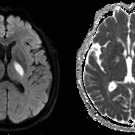 Mri Of A New Infarction In Basal Ganglia Regions Download Scientific