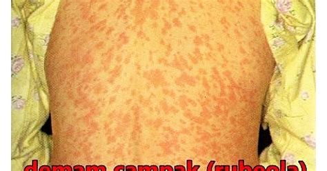 Chickenpox is a virus that causes red, itchy bumps. Beza Demam Campak Dan Chicken Pox