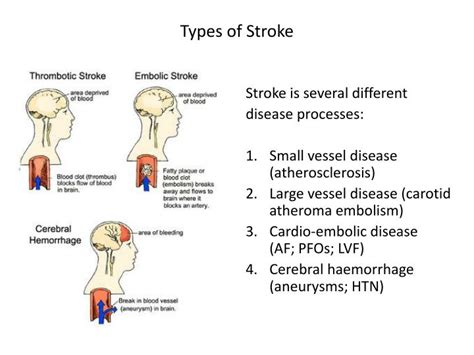 Ppt Stroke Acute Care And Thrombolysis Adrian Pace Neurology Spr