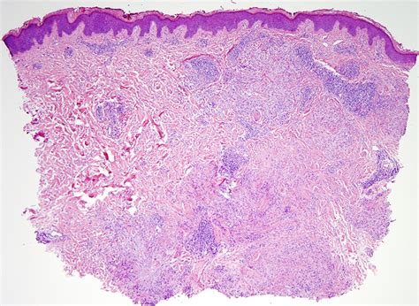 Granuloma Annulare Histopathology
