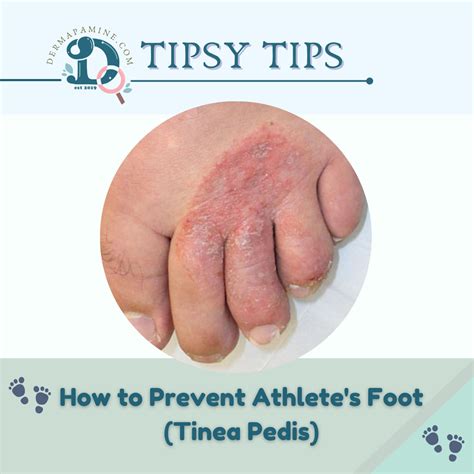 How To Prevent Athletes Foot Tinea Pedis Dermapamine By