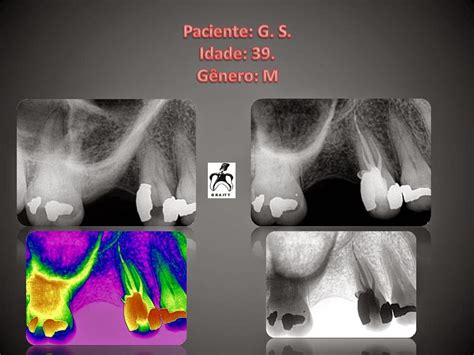 Endodontia Dr Henrique Braitt Tratamento Endod Ntico Em Pr Molar Superior Com Canais A