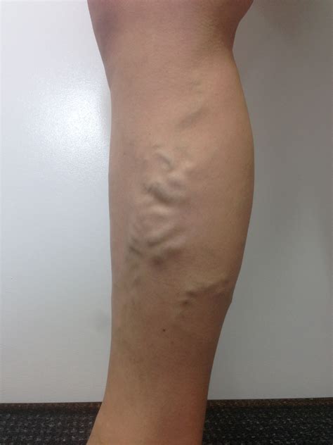 Varicose Vein Results And Post Treatment Photos — The Leg Vein Doctor Brisbane Varicose