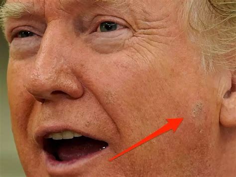 Photos Of A A Scaly Discolored Patch Of Skin On Trumps Face Have Gone