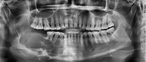 Oral And Maxillofacial Surgery Newcastle Hospitals Nhs Foundation Trust