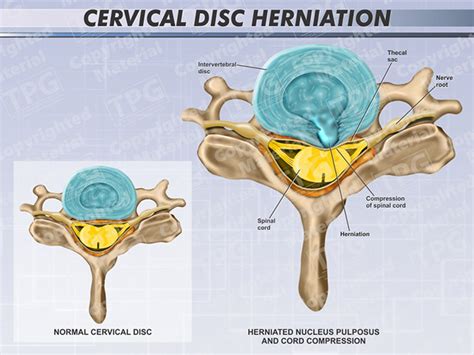 Cervical Herniation