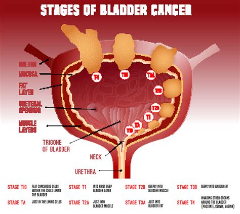 What Is The Most Common Cause Of Bladder Cancer Updated