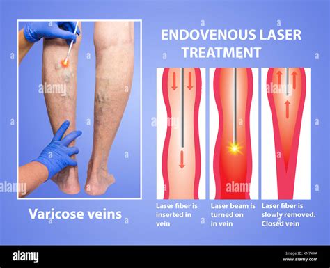 Varicose Veins Endovenous Laser Treatment Of Female Legs Stock Photo