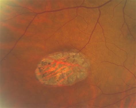 Congenital Hypertrophy Of The Retinal Pigment Epithelium Chrpe