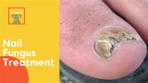 Nail Fungus Treatment Dr Saeed Diabetes Clinic And Foot Care Center