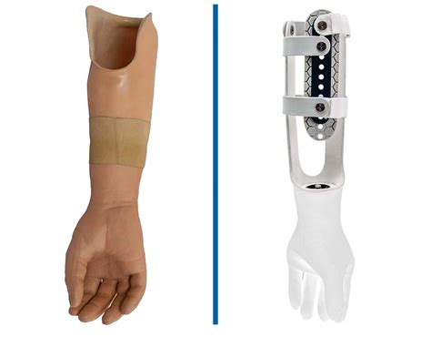 Below Elbow Socket Less Socket™ — Martin Bionics
