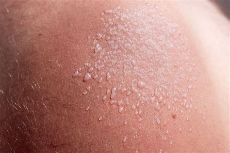 Sun Blister Heres How To Tell If You Have One And How To Treat It