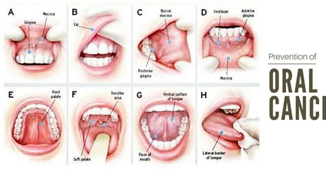 Early Symptoms And Possible Prevention Of Oral Cancer Latest Dental