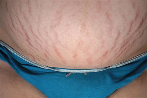 Stretch Marks In Pregnancy NHS